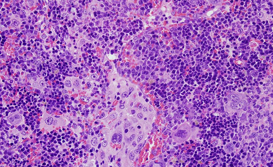 Imagen de microscopía del bazo de un ratón que ha desarrollado un linfoma periférico de células T a causa de alteraciones en el gen VAV1. Foto USAL